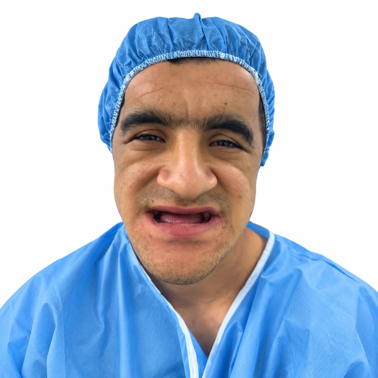 ایمپلنت — مورد 2 — قبل