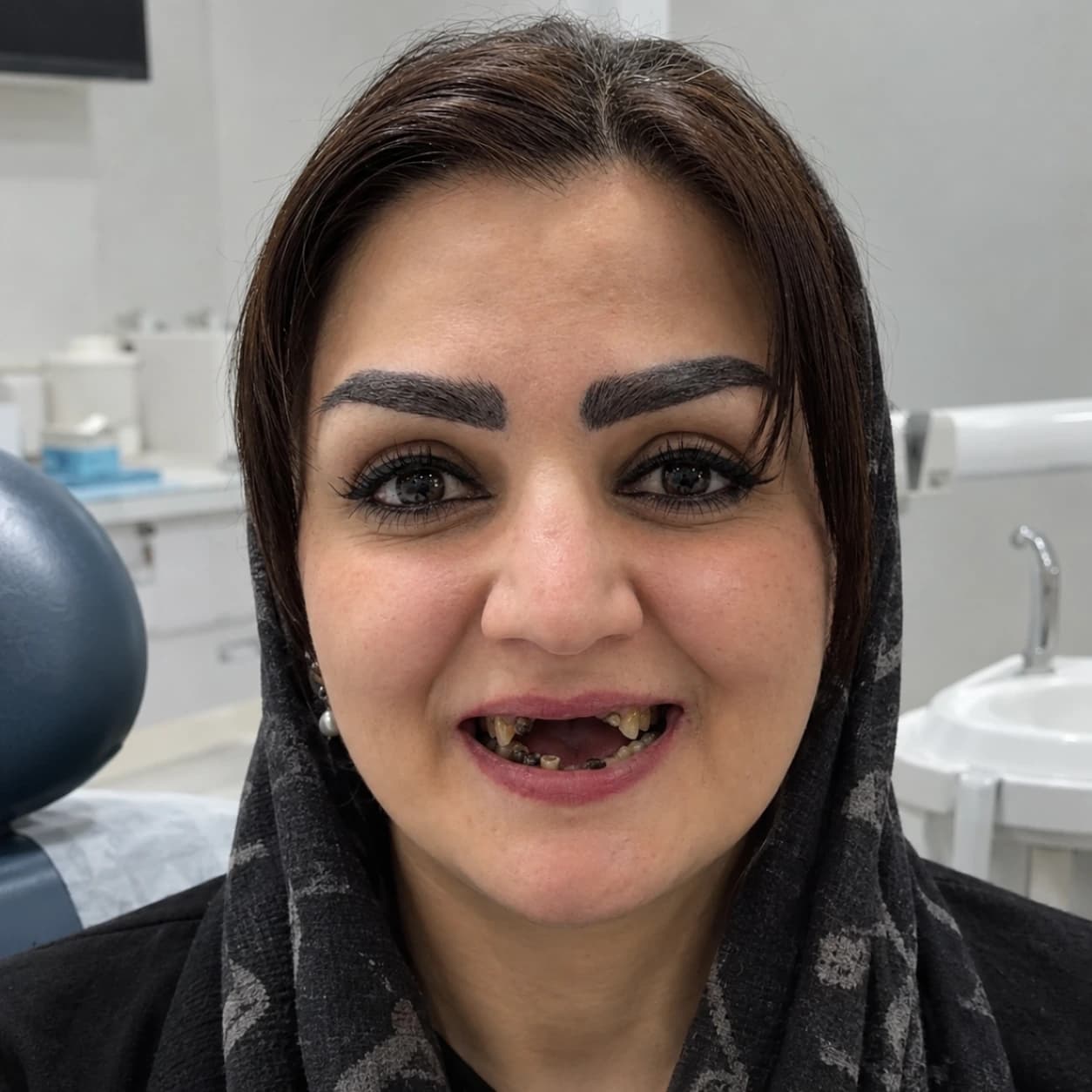 ایمپلنت — مورد 3 — قبل