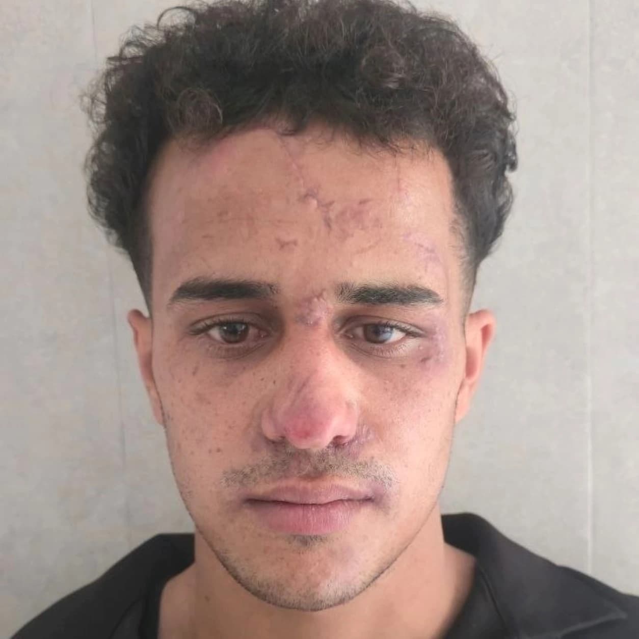 بازسازی نواقص صورت — مورد 1 — بعد