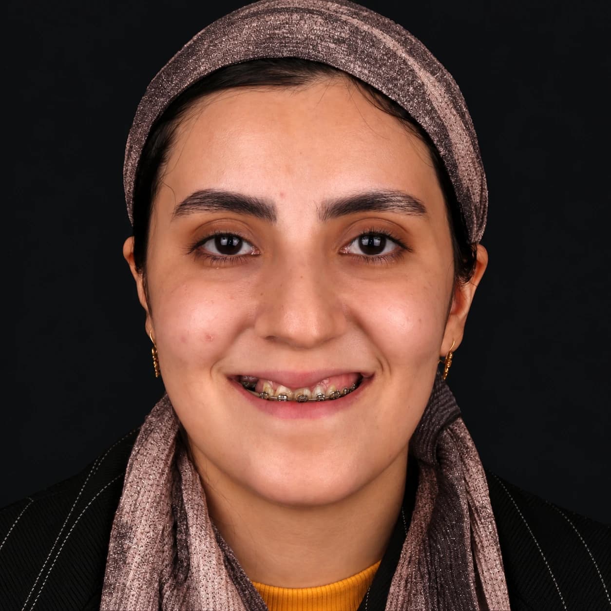جراحی فک — مورد 1 — قبل