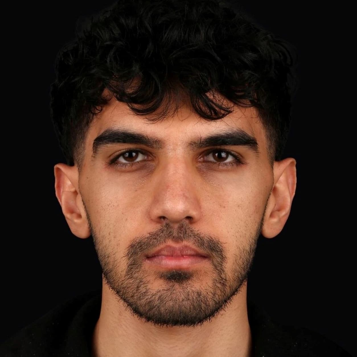 جراحی فک — مورد 2 — بعد