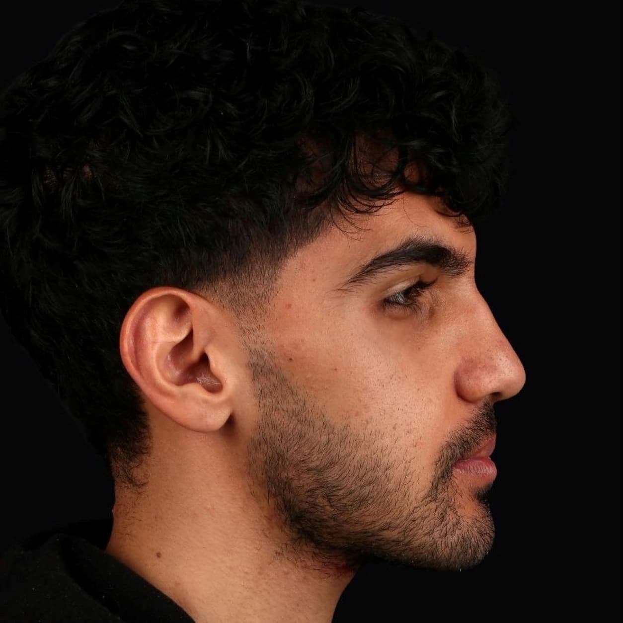 جراحی فک — مورد 3 — بعد