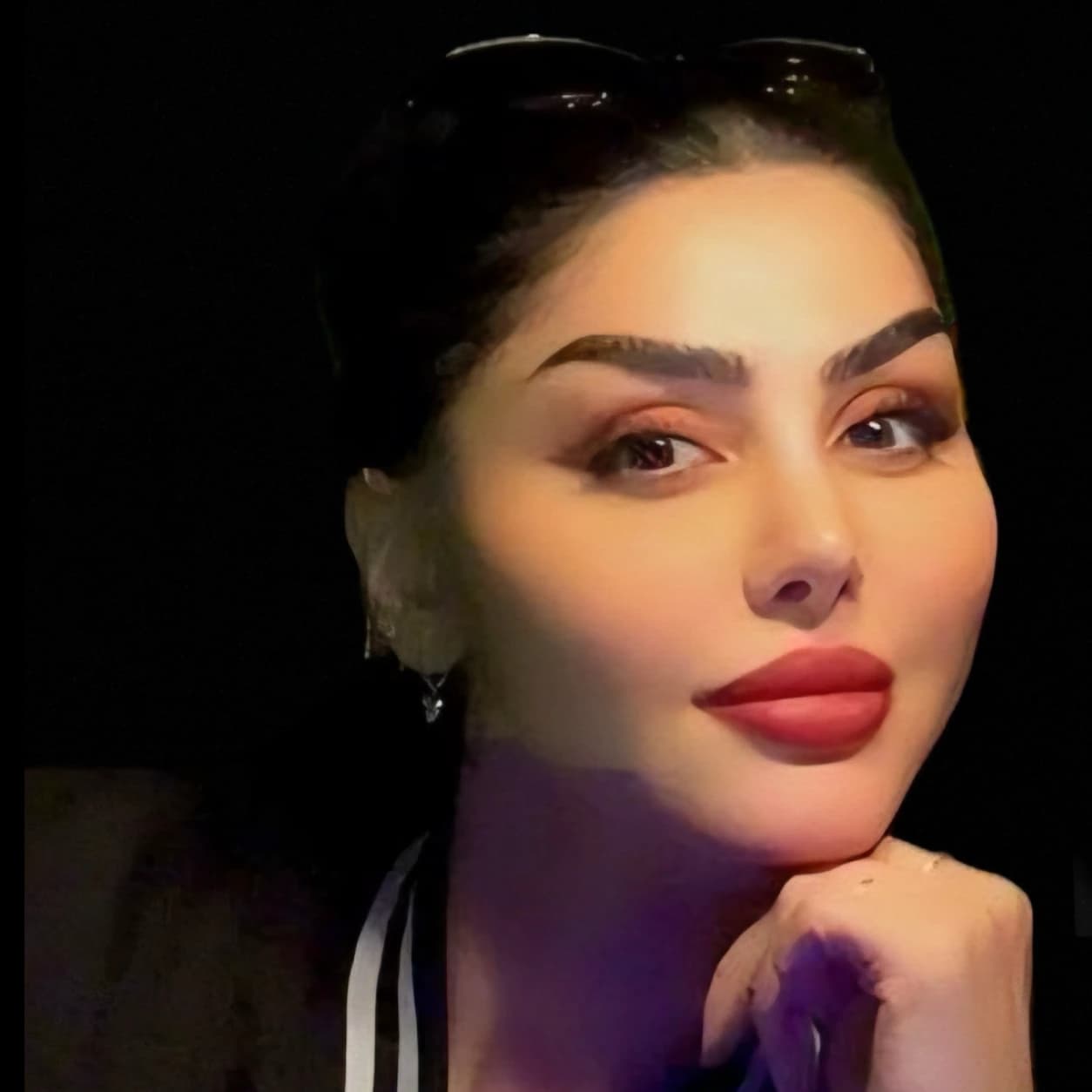 لیفت شقیقه و صورت — مورد 1 — بعد