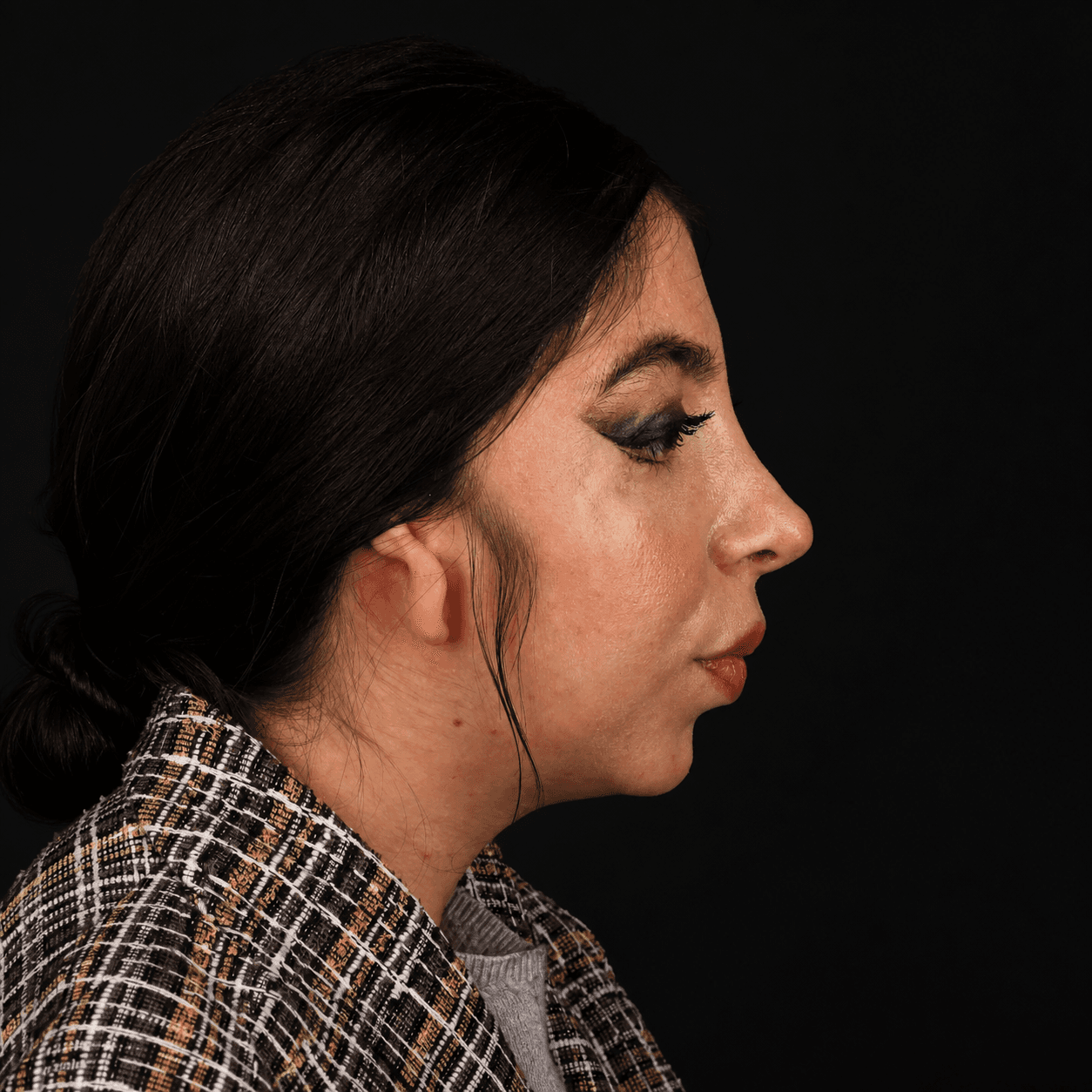 Facial Reconstruction — Case 2 — After