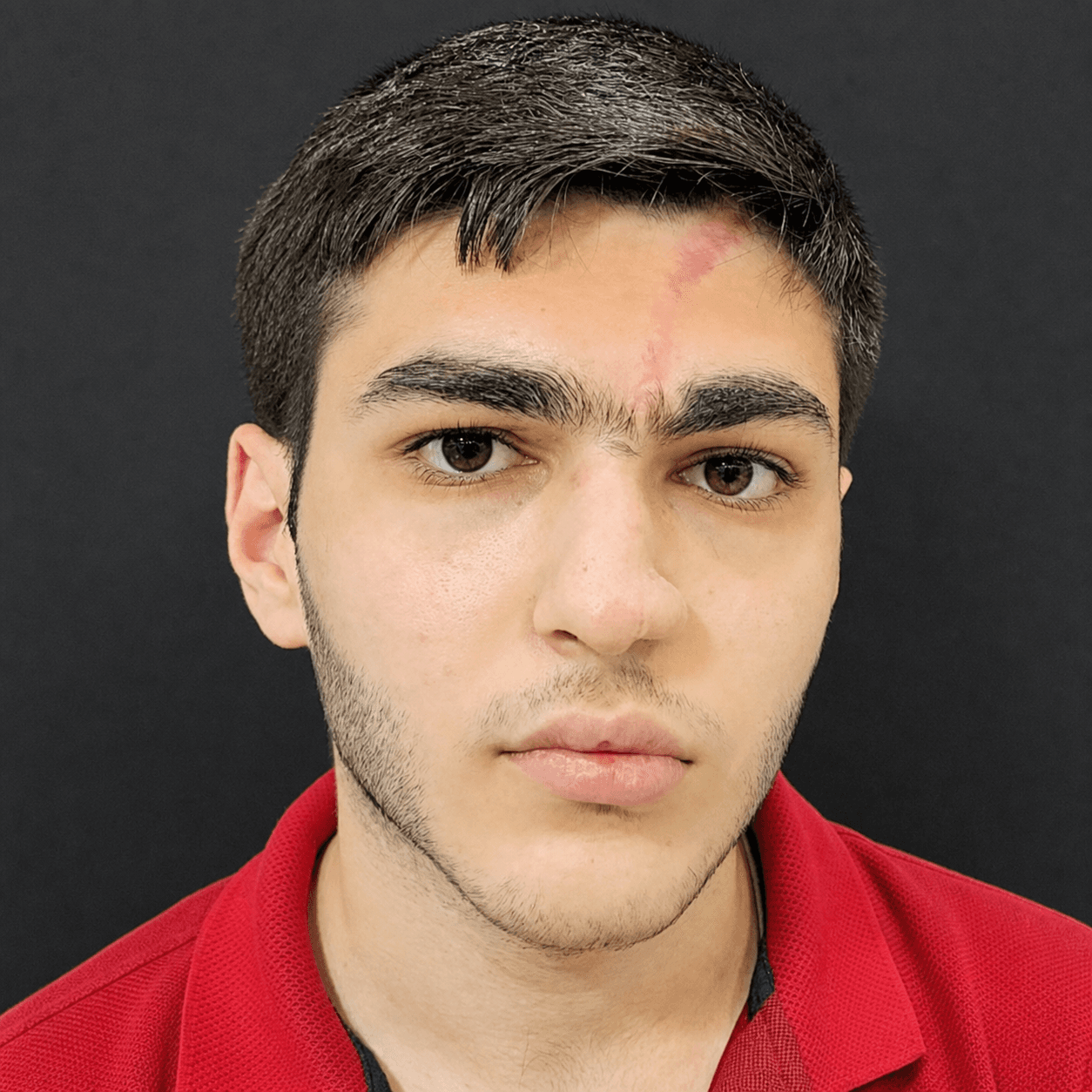 Facial Reconstruction — Case 4 — After