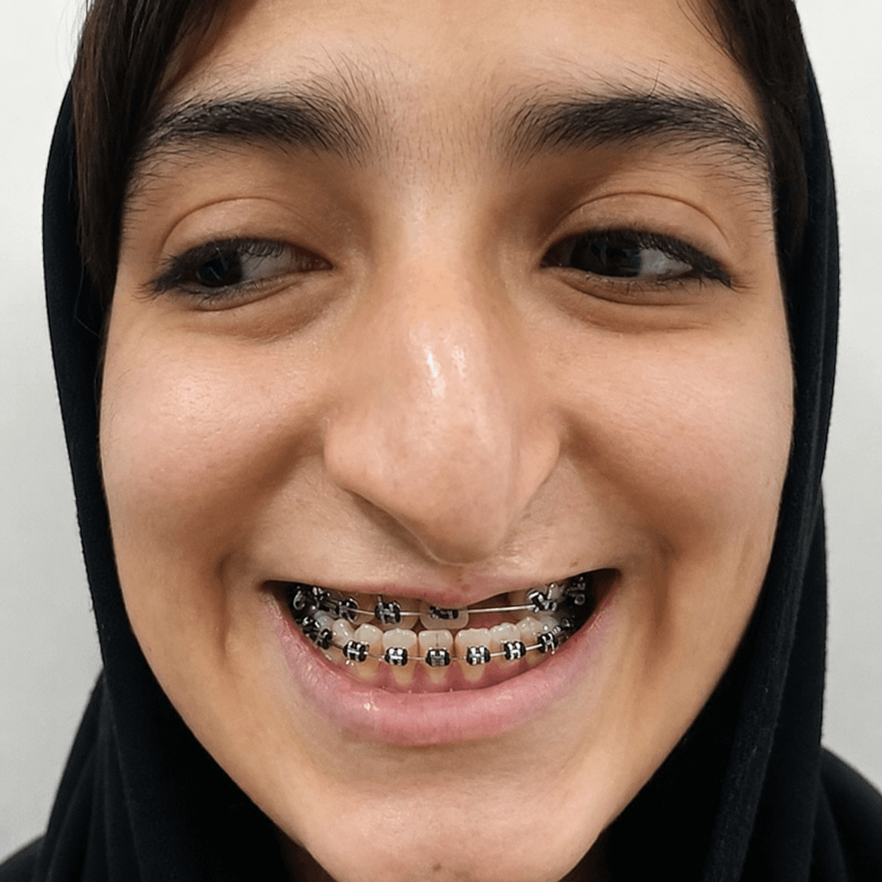Facial Reconstruction — Case 1 — Before