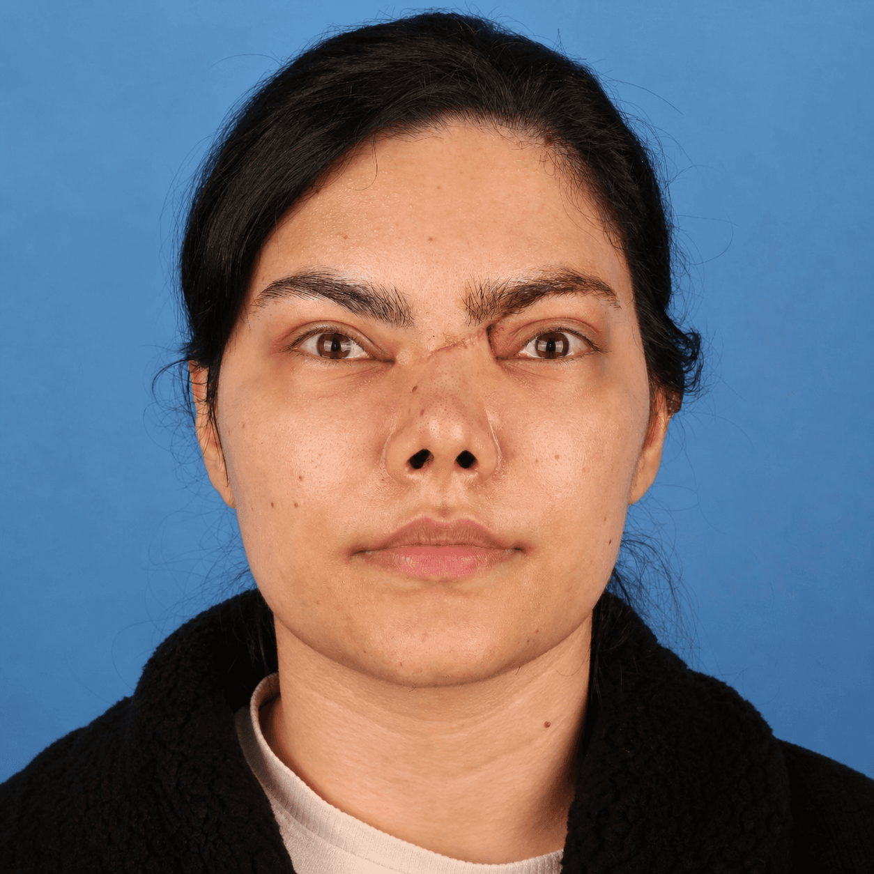 Facial Reconstruction — Case 3 — Before