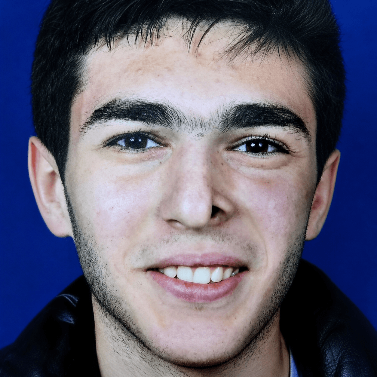 Facial Reconstruction — Case 4 — Before