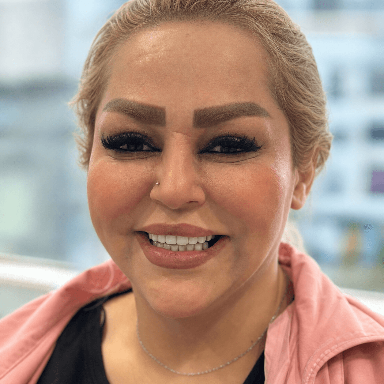 Dental Implant — Case 2 — After