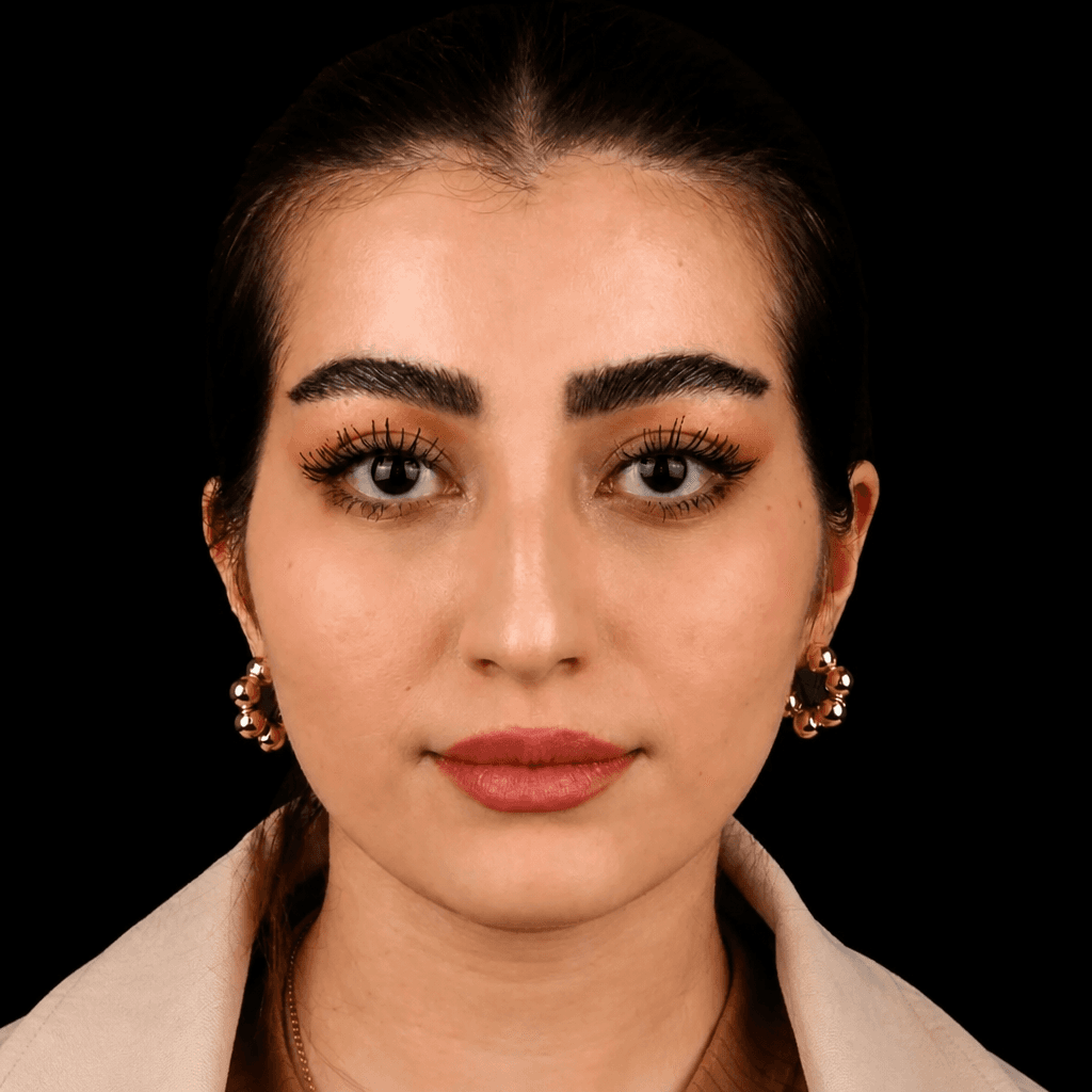 Jaw Surgery — Case 1 — After