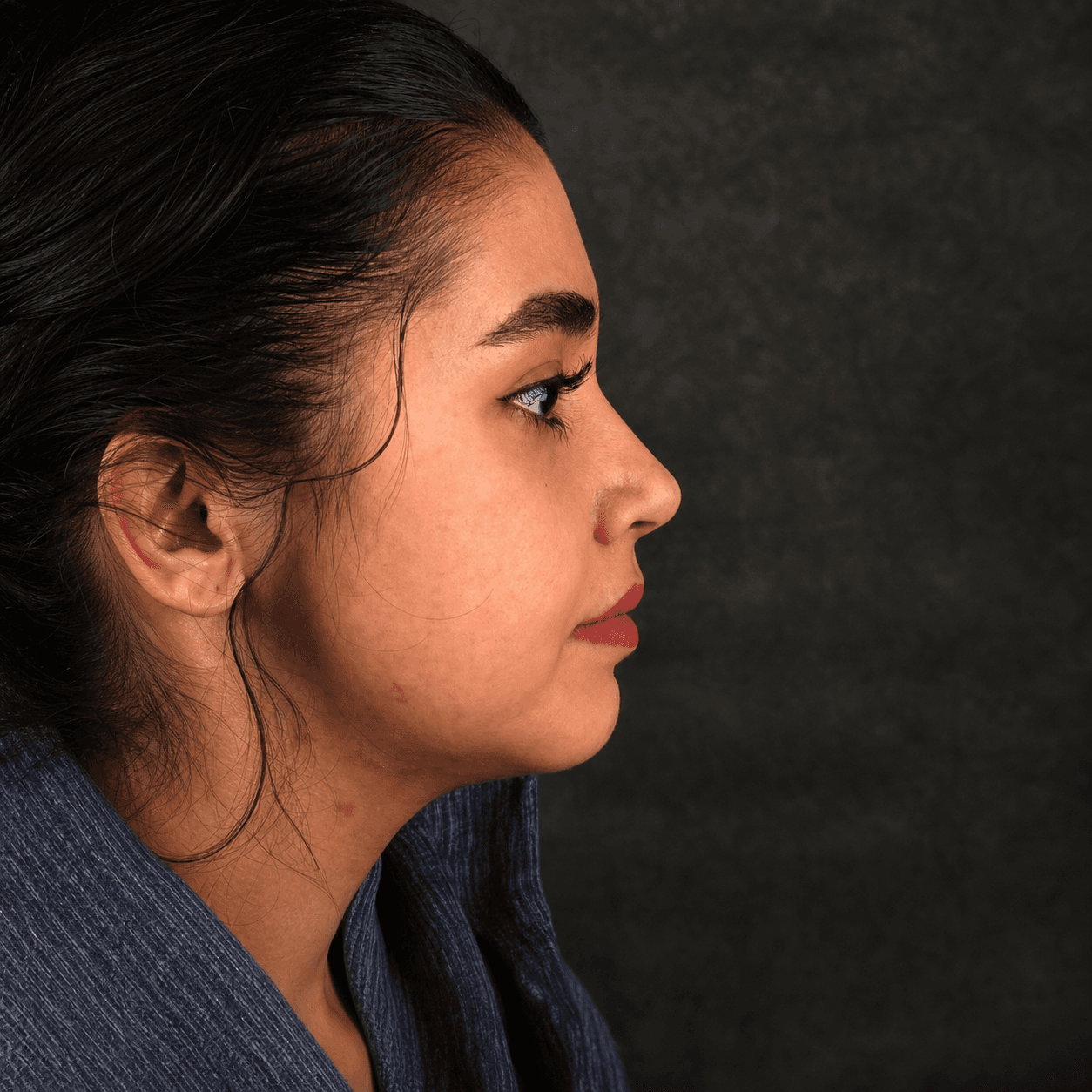 Jaw Surgery — Case 2 — After