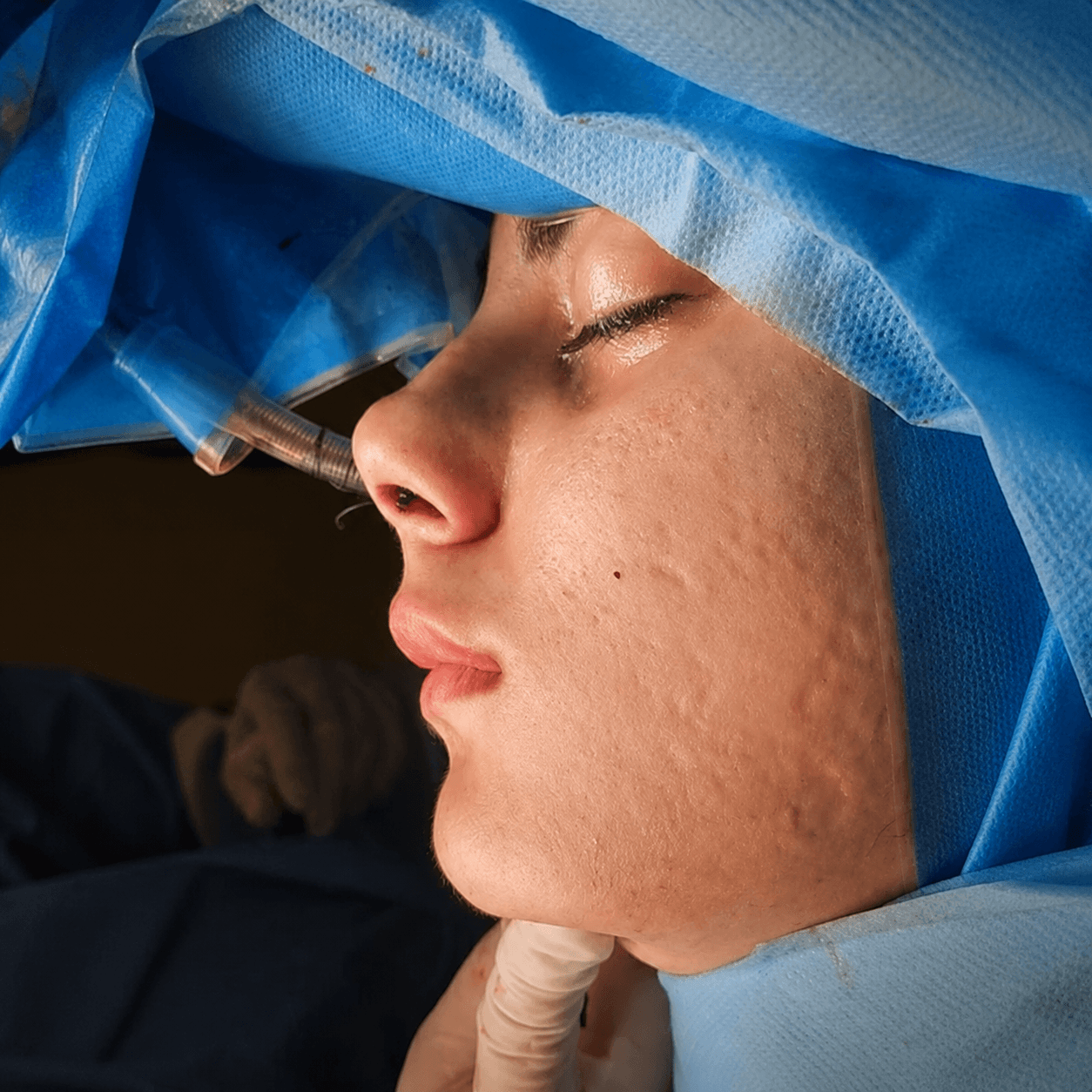 Jaw Surgery — Case 4 — After