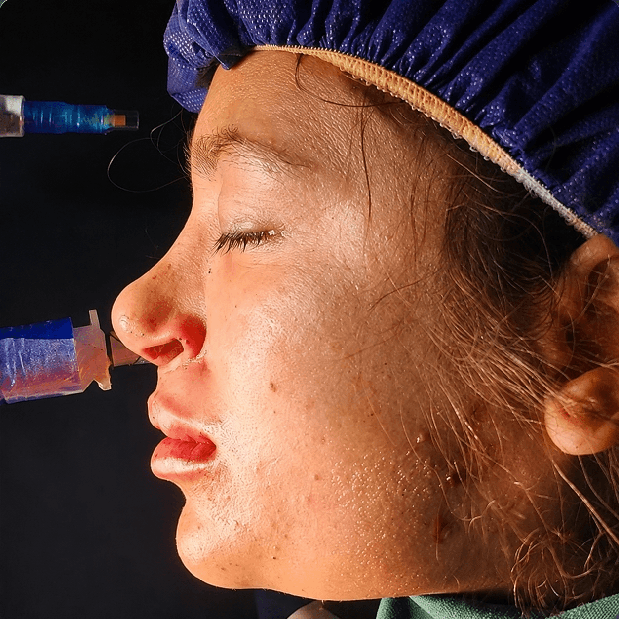 Jaw Surgery — Case 5 — After