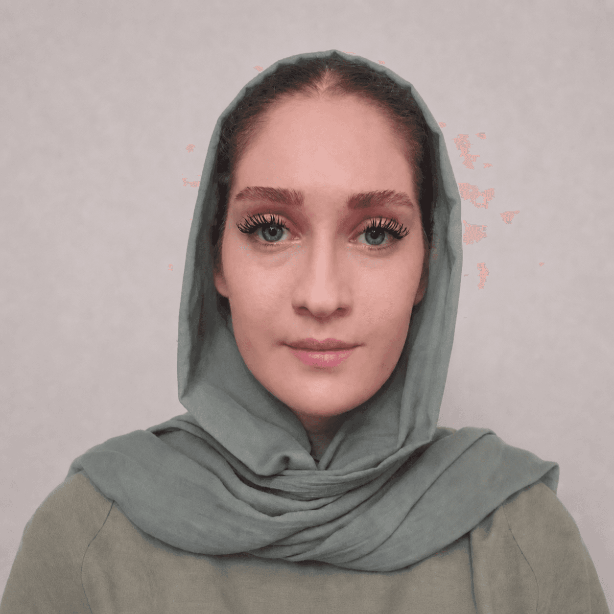 Jaw Surgery — Case 10 — After