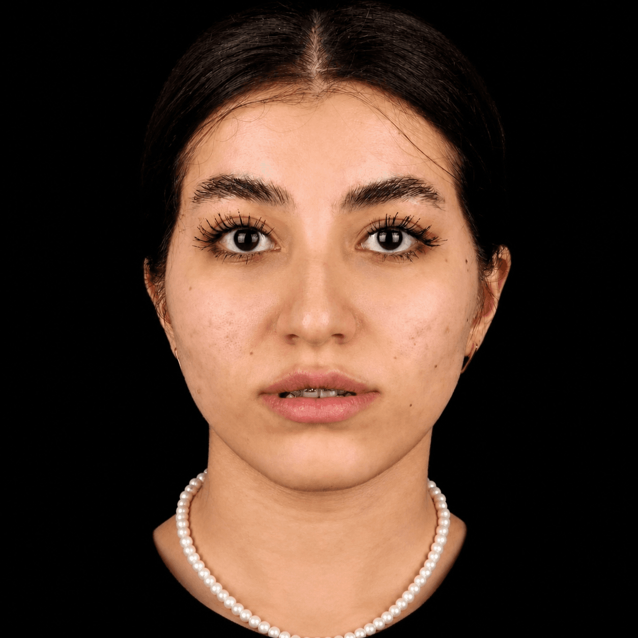 Jaw Surgery — Case 1 — Before