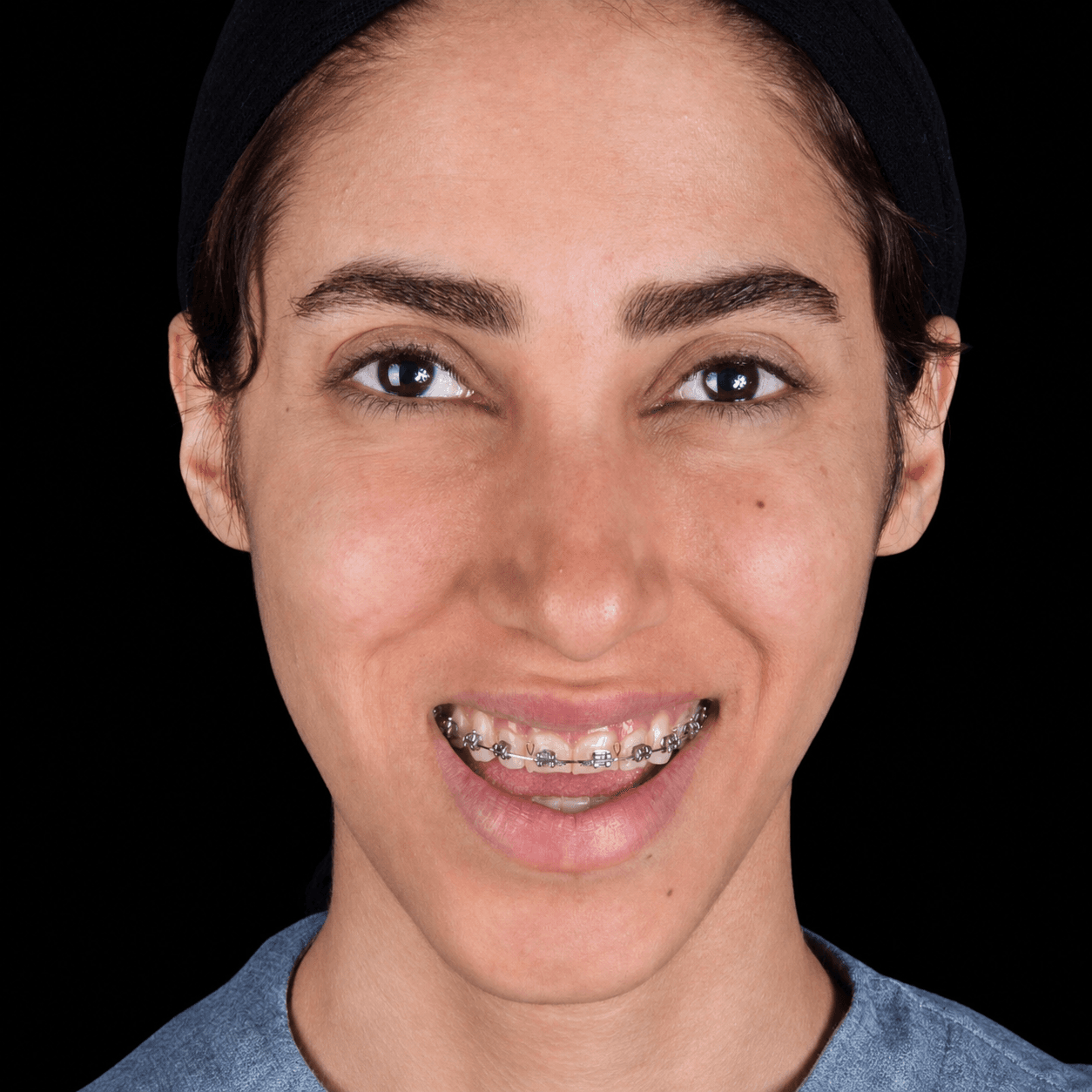 Jaw Surgery — Case 3 — Before
