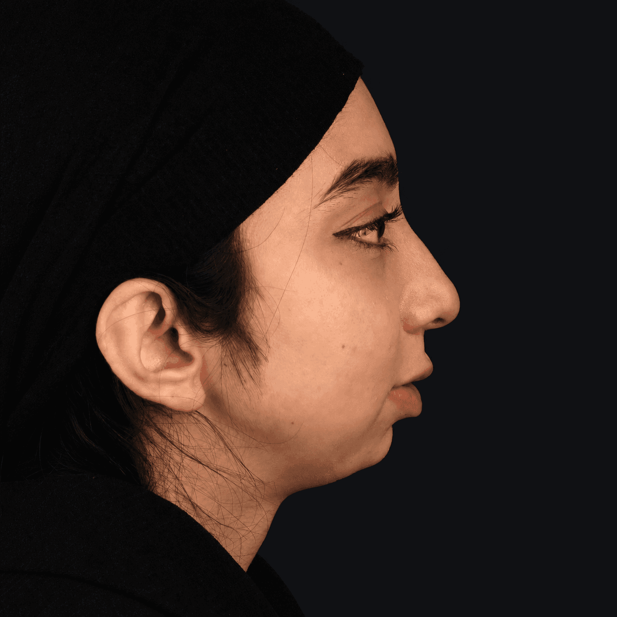 Jaw Surgery — Case 6 — Before