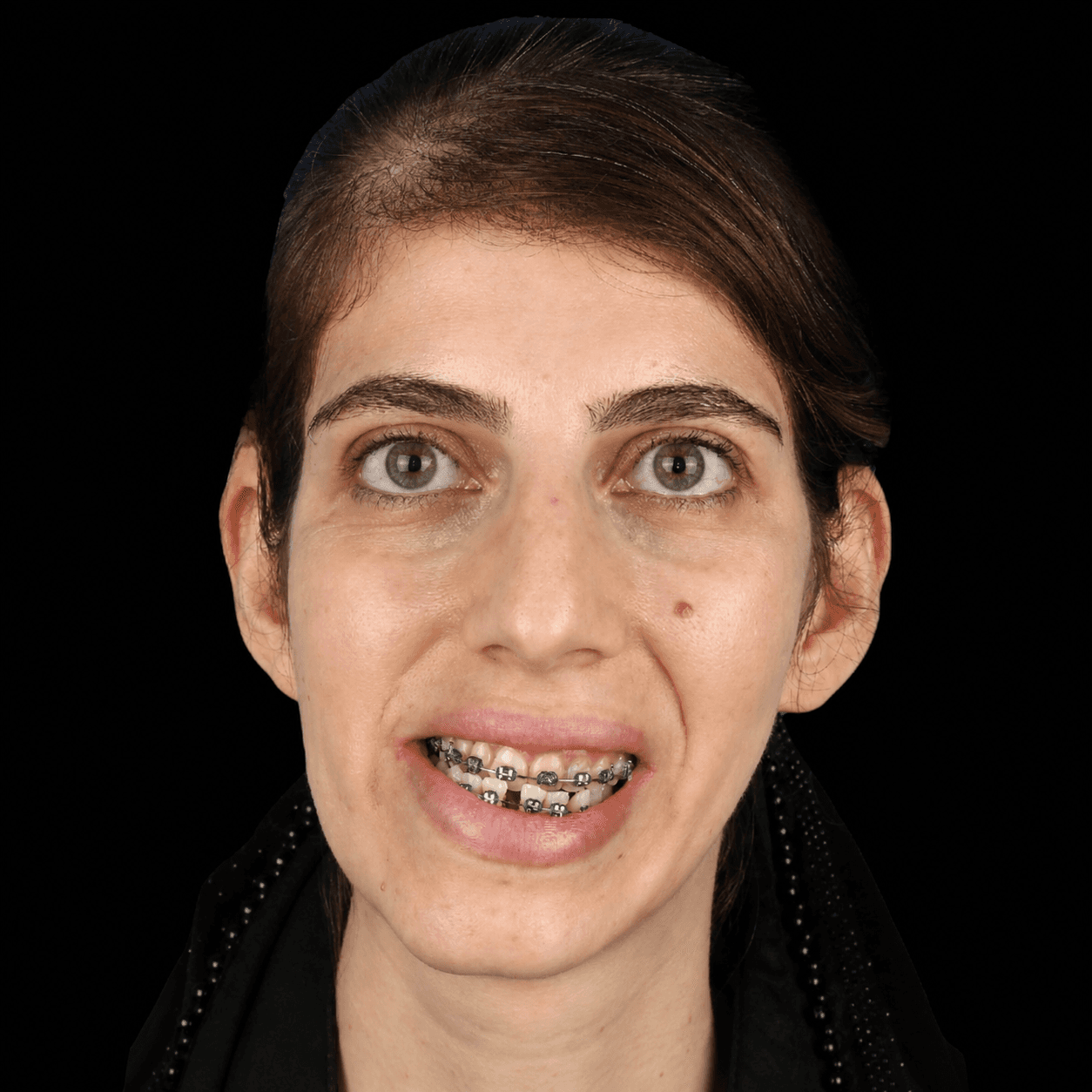 Jaw Surgery — Case 9 — Before