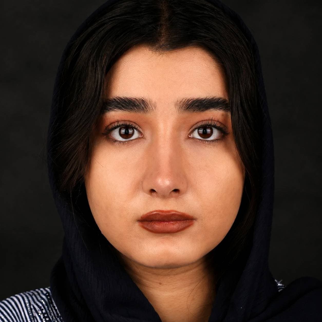 Rhinoplasty — Case 4 — After