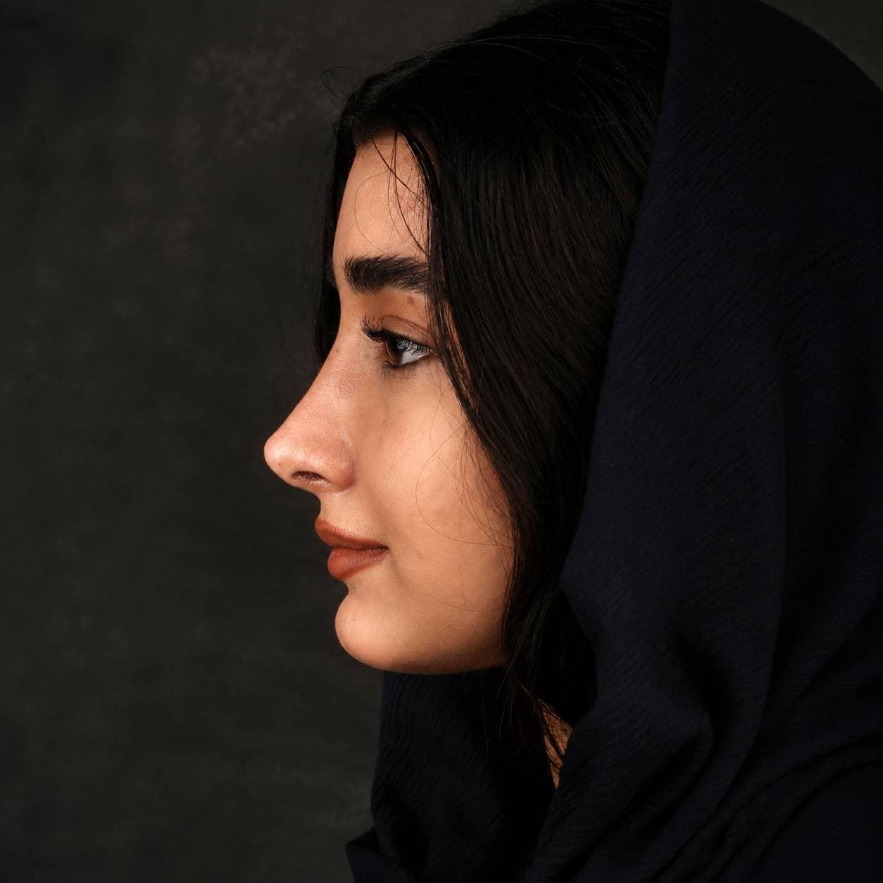 Rhinoplasty — Case 5 — After