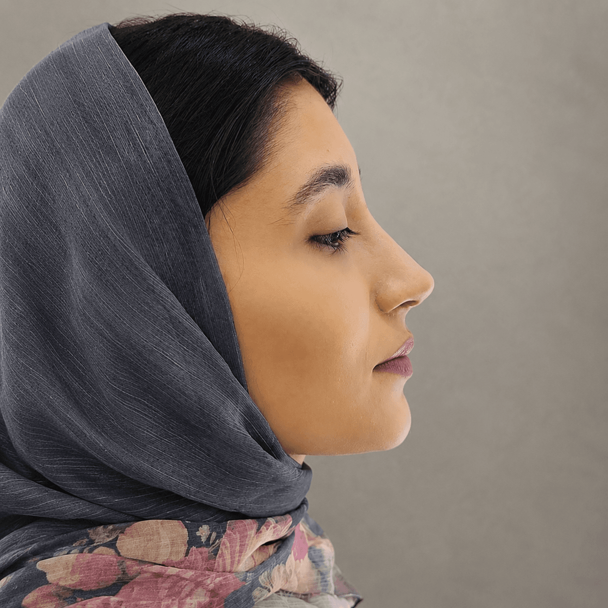 Rhinoplasty — Case 2 — After