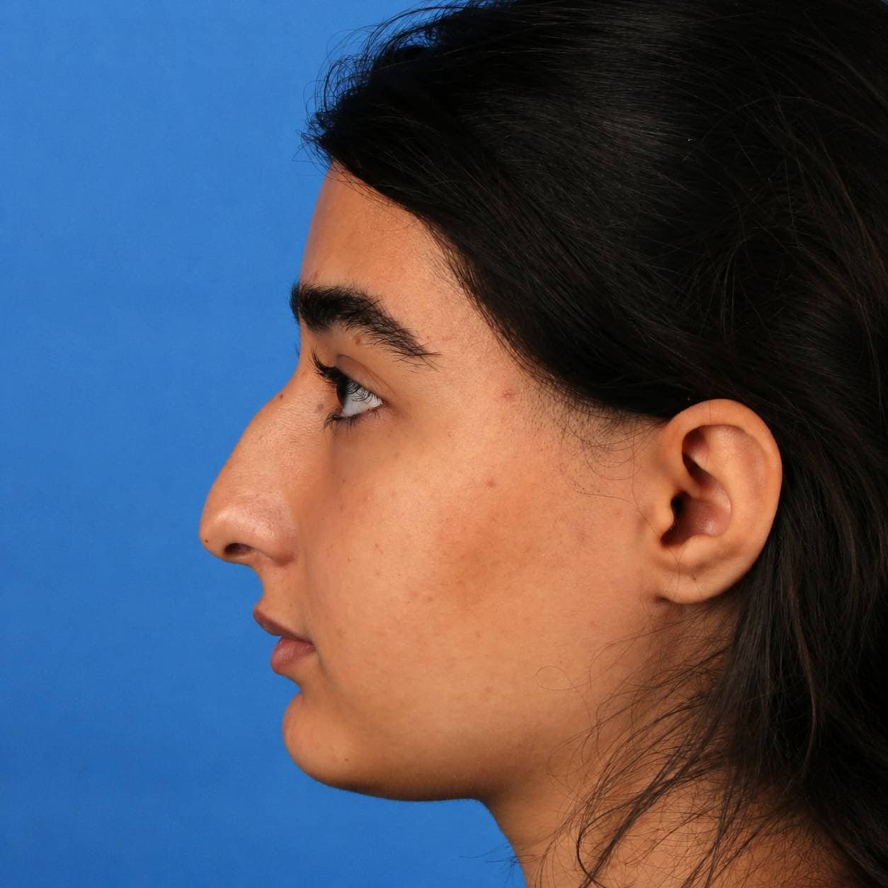 Rhinoplasty — Case 4 — Before