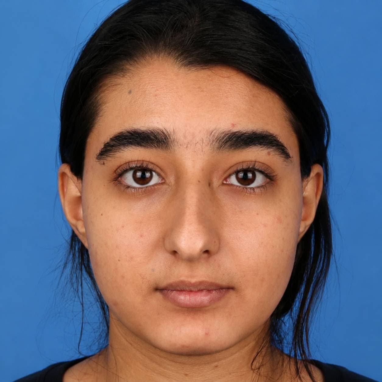 Rhinoplasty — Case 5 — Before