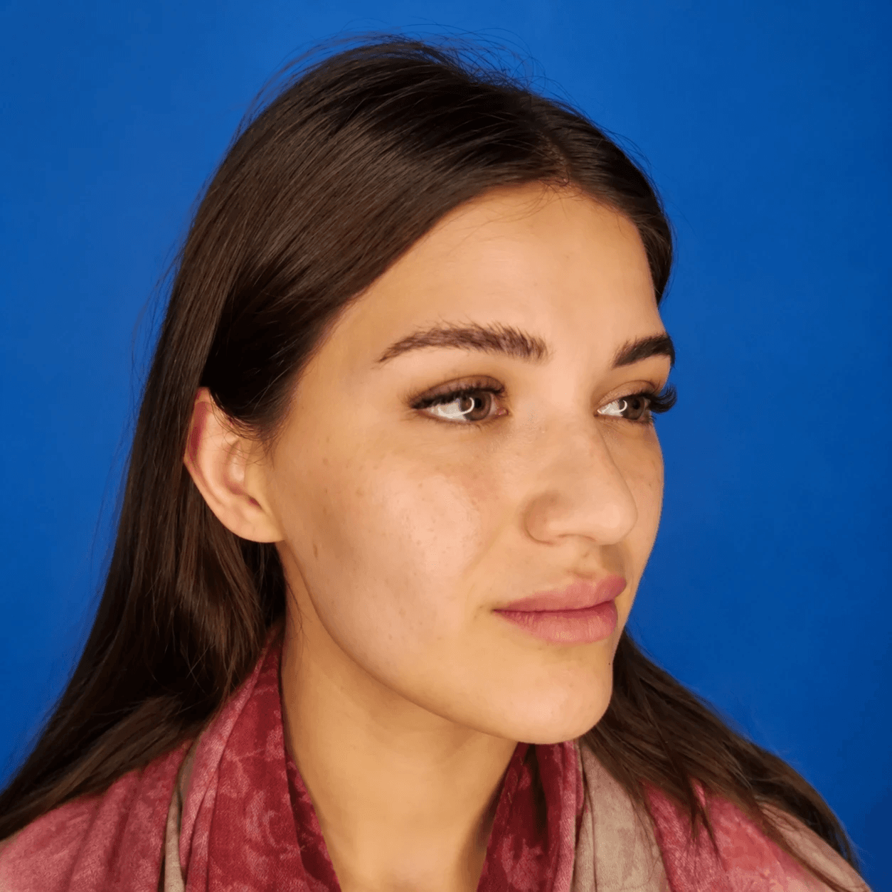 Rhinoplasty — Case 6 — Before