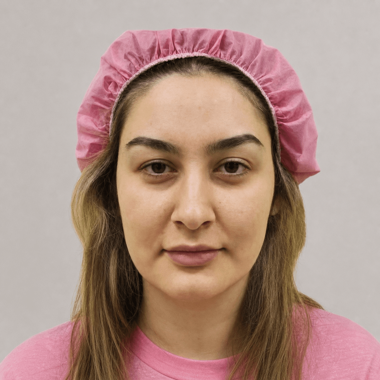 Rhinoplasty — Case 7 — Before