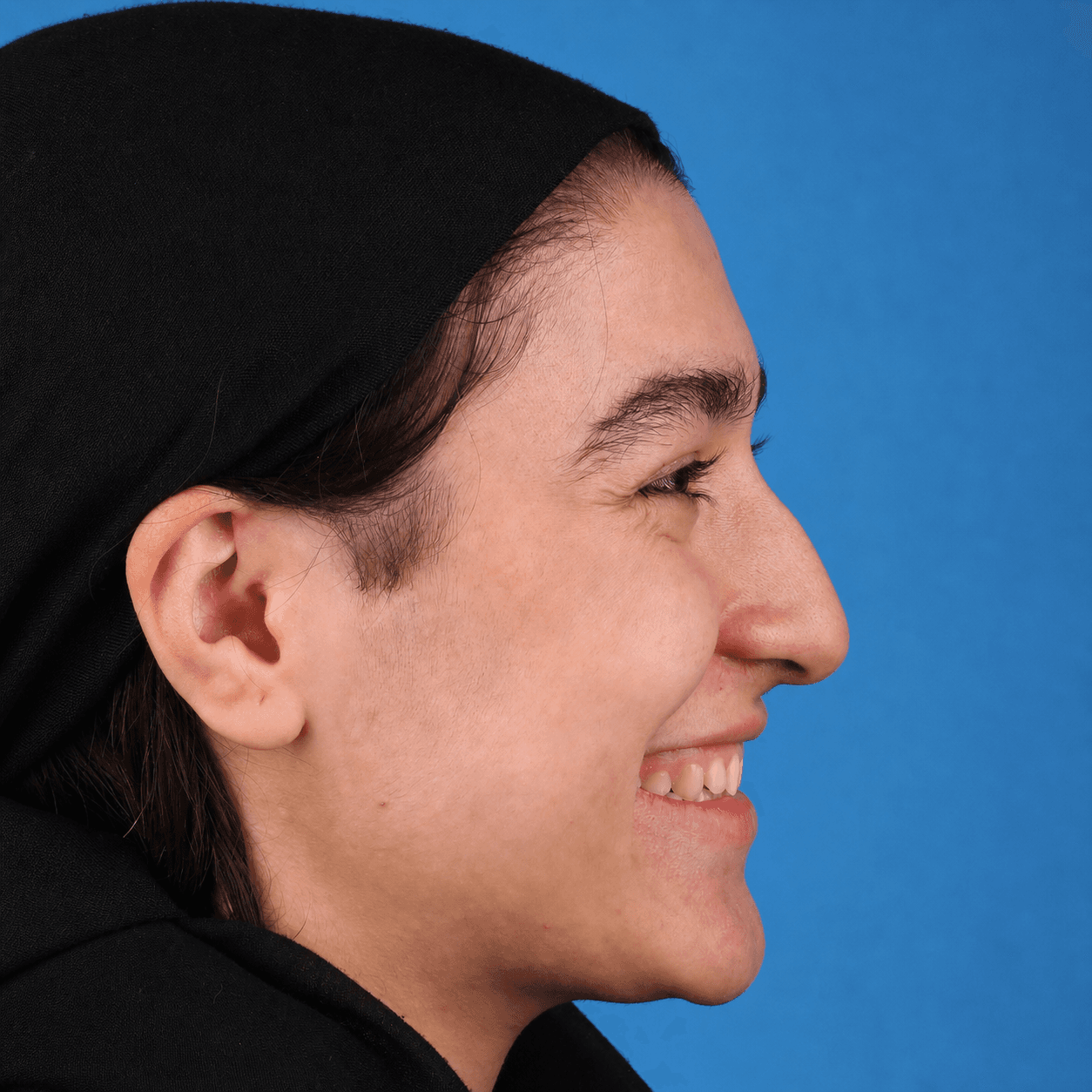 Rhinoplasty — Case 1 — Before