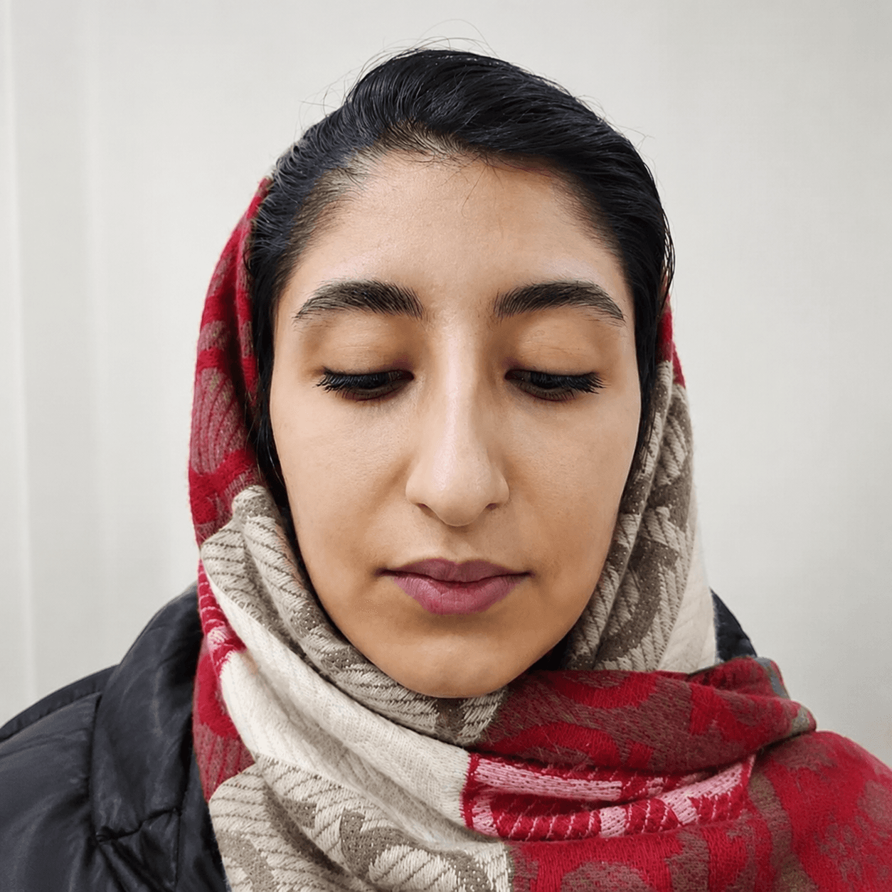 Rhinoplasty — Case 2 — Before