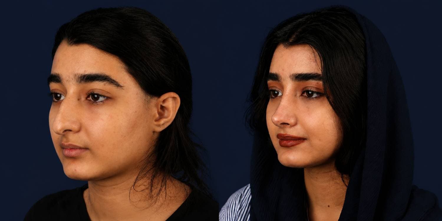 جراحة تجميل الأنف