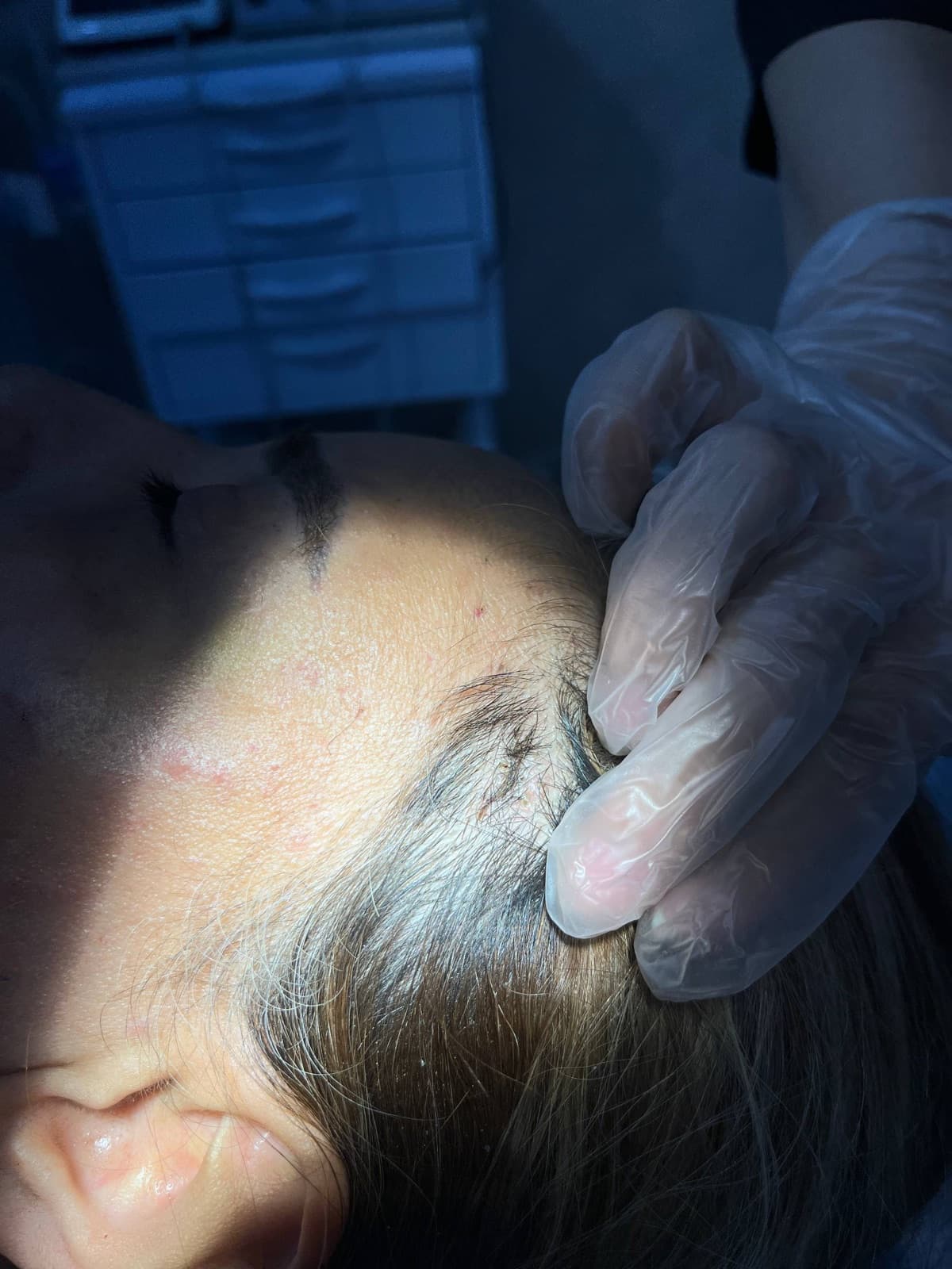 Clinical view of the S Lift incision at the hairline