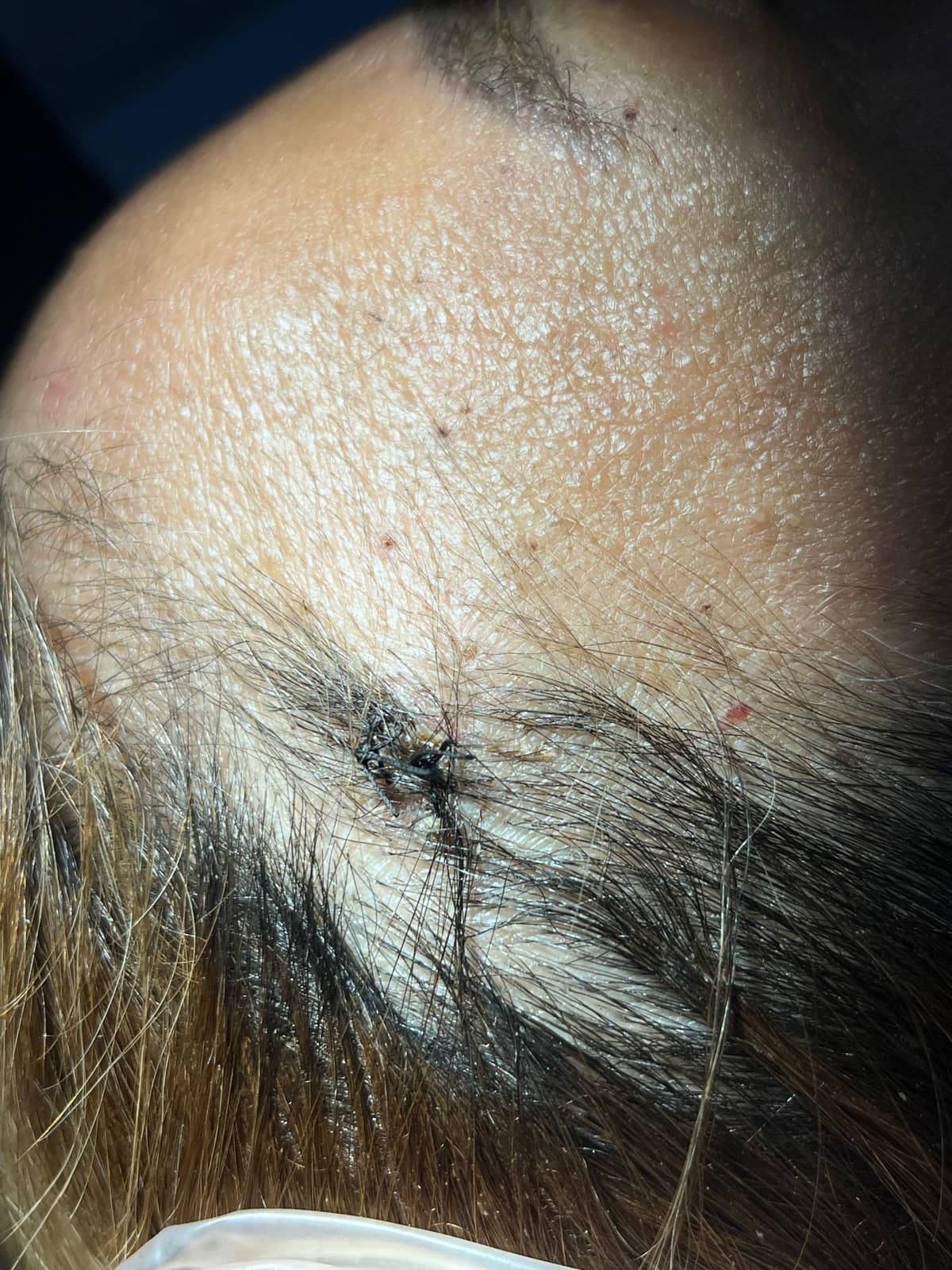 Close-up view of the skin sutures at the S Lift temple incision