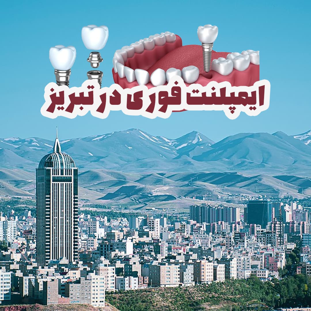 ایمپلنت فوری در تبریز: کاشت دندان در یک روز با تکنولوژی پیشرفته در کلینیک دکتر صدیقی
