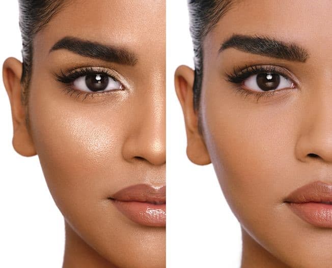 لیفت شقیقه گلایدینگ؛ روش کم‌تهاجمی برای جوانسازی اطراف چشم و شقیقه